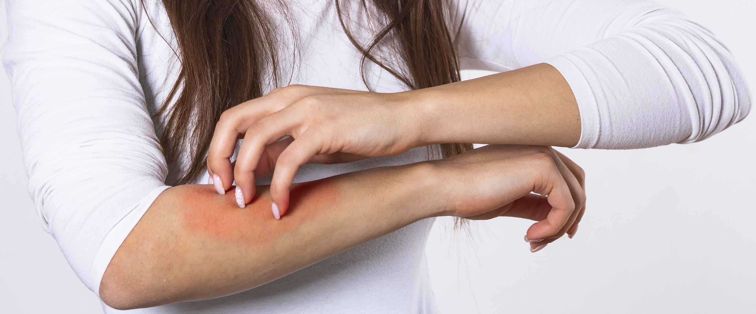 Seborrheic Dermatitis